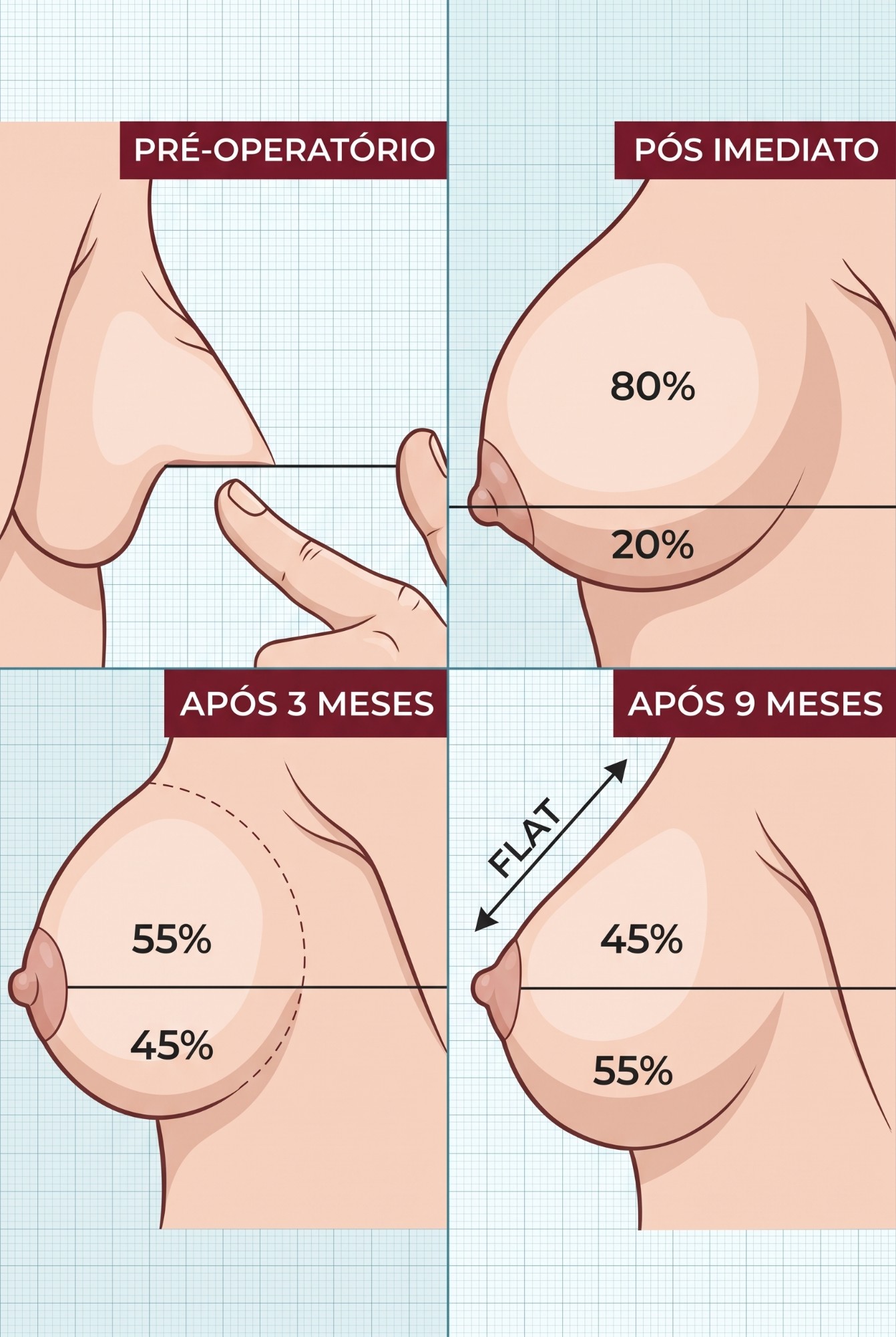 Ilustração didática em quatro quadros mostrando a evolução da mama após a mastopexia: pré-operatório, pós imediato, 3 meses e 9 meses